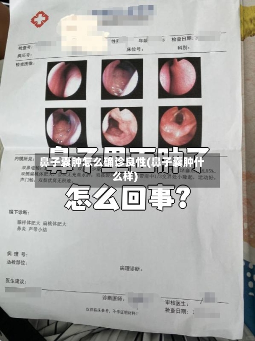 鼻子囊肿怎么确诊良性(鼻子囊肿什么样)-第2张图片