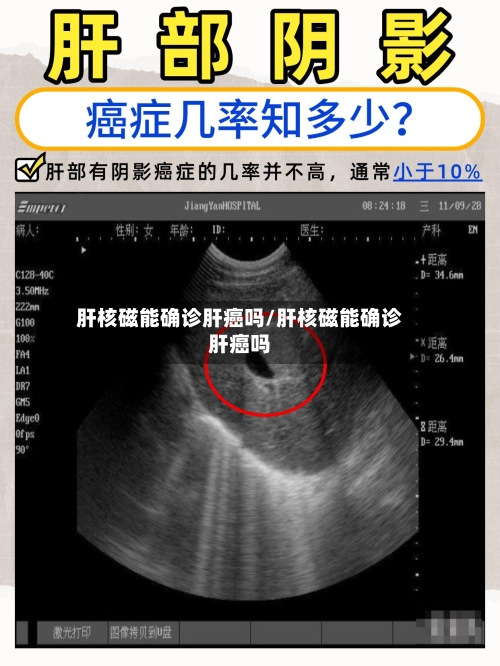 肝核磁能确诊肝癌吗/肝核磁能确诊肝癌吗-第2张图片