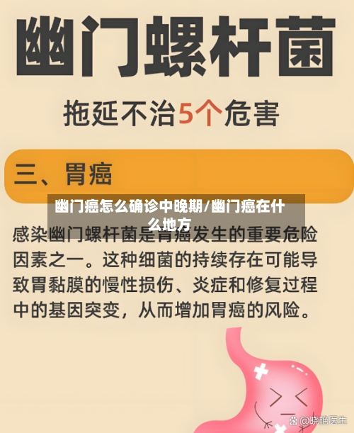 幽门癌怎么确诊中晚期/幽门癌在什么地方