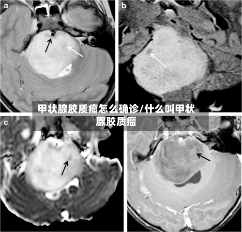 甲状腺胶质瘤怎么确诊/什么叫甲状腺胶质瘤
