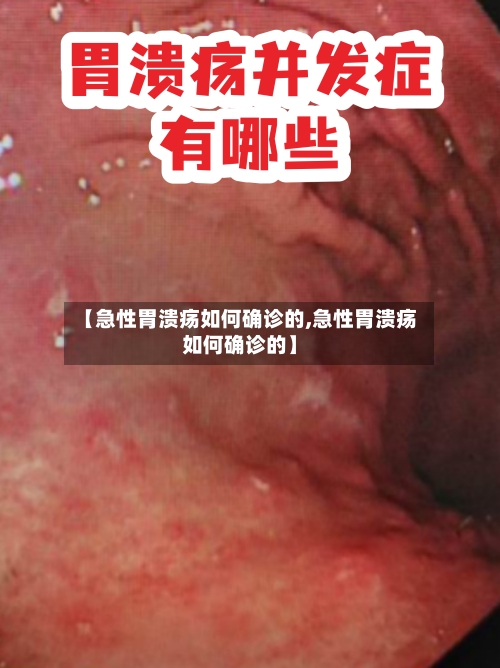 【急性胃溃疡如何确诊的,急性胃溃疡如何确诊的】