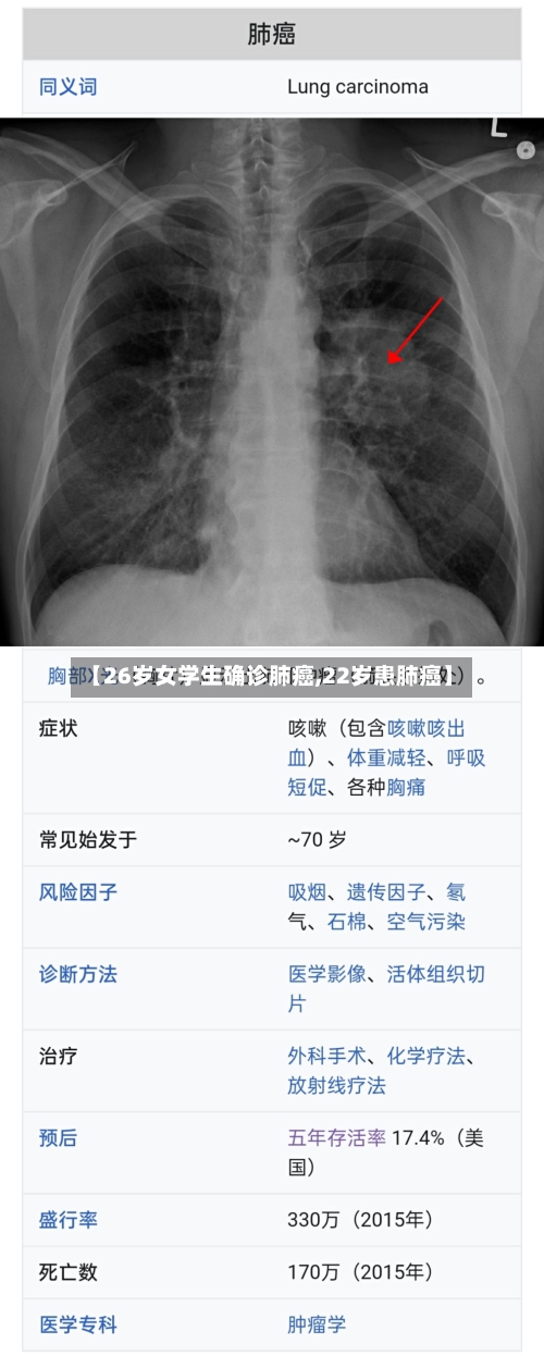 【26岁女学生确诊肺癌,22岁患肺癌】-第2张图片