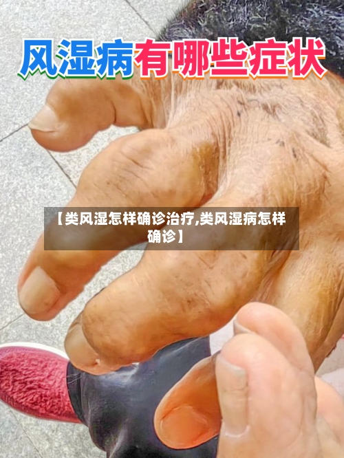 【类风湿怎样确诊治疗,类风湿病怎样确诊】
