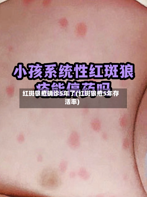 红斑狼疮确诊5年了(红斑狼疮5年存活率)-第2张图片