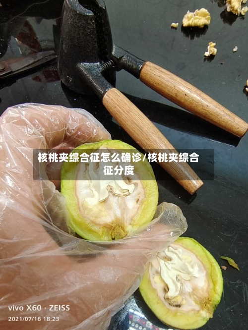 核桃夹综合征怎么确诊/核桃夹综合征分度