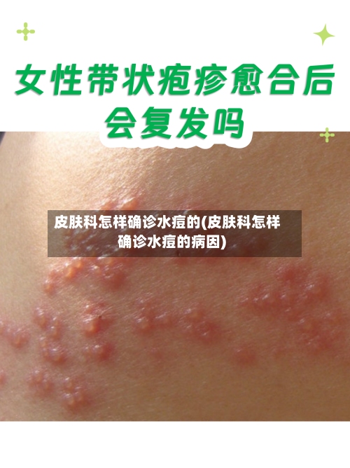 皮肤科怎样确诊水痘的(皮肤科怎样确诊水痘的病因)-第2张图片