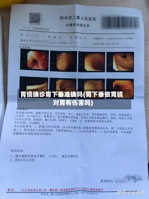 胃镜确诊胃下垂准确吗(胃下垂做胃镜对胃有伤害吗)