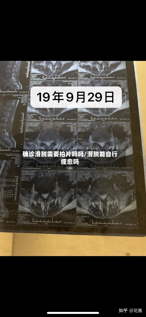 确诊滑脱需要拍片吗吗/滑脱能自行痊愈吗