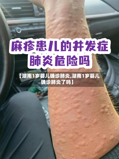 【湖南1岁婴儿确诊肺炎,湖南1岁婴儿确诊肺炎了吗】-第2张图片