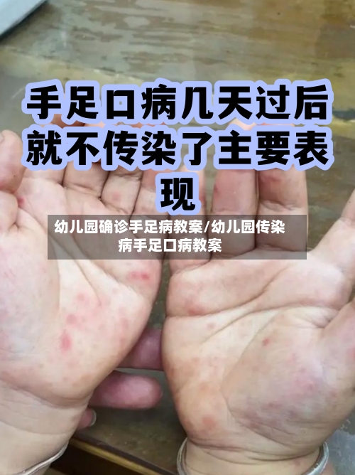 幼儿园确诊手足病教案/幼儿园传染病手足口病教案