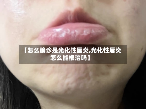 【怎么确诊是光化性唇炎,光化性唇炎怎么能根治吗】-第2张图片