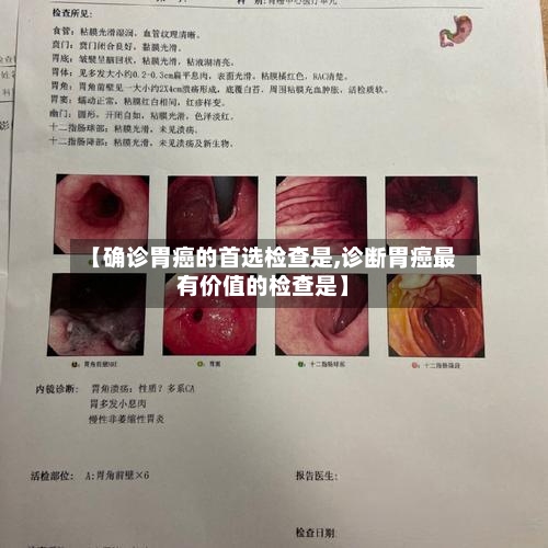 【确诊胃癌的首选检查是,诊断胃癌最有价值的检查是】-第3张图片