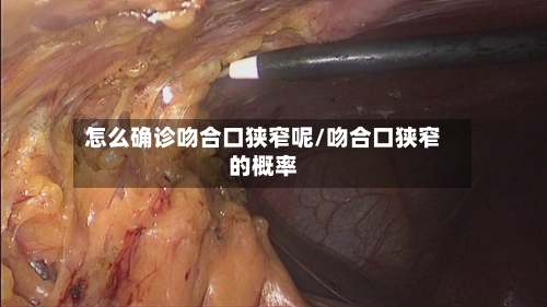 怎么确诊吻合口狭窄呢/吻合口狭窄的概率